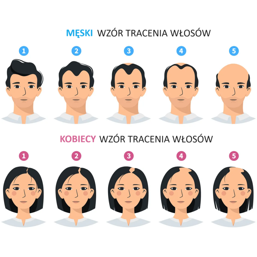 Wzór tracenia włosów mężczyzn i kobiet