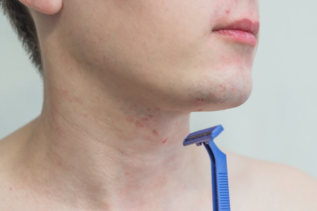 Męska twarz nastolatka z podrażnieniami po goleniu trzymającego jednorazową maszynkę do golenia