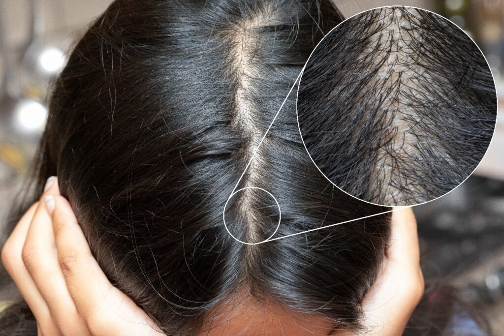 Skalp kobiety, obok powiększenie przerzedzonych włosów