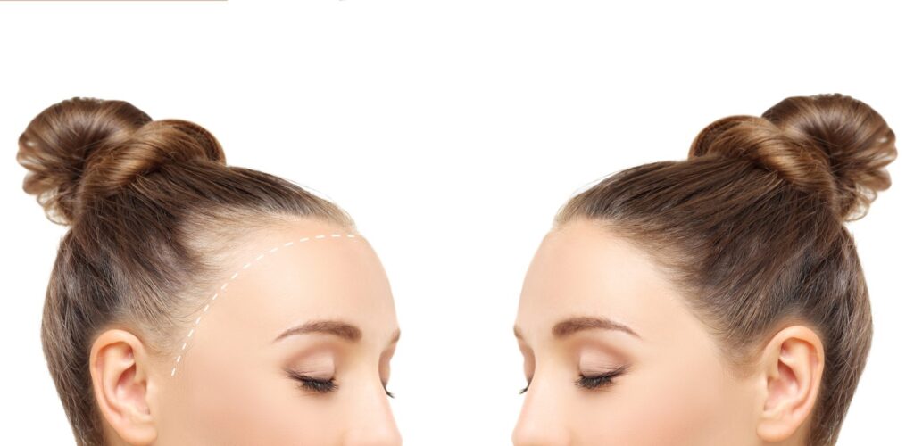 Porównanie tej samej kobiety bez i z łysieniem androgenowym