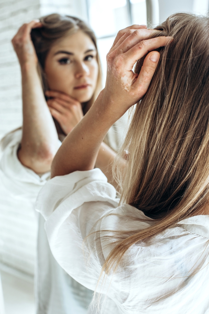 Młoda kobieta z łuszczycą głowy przegląda się w lustrze