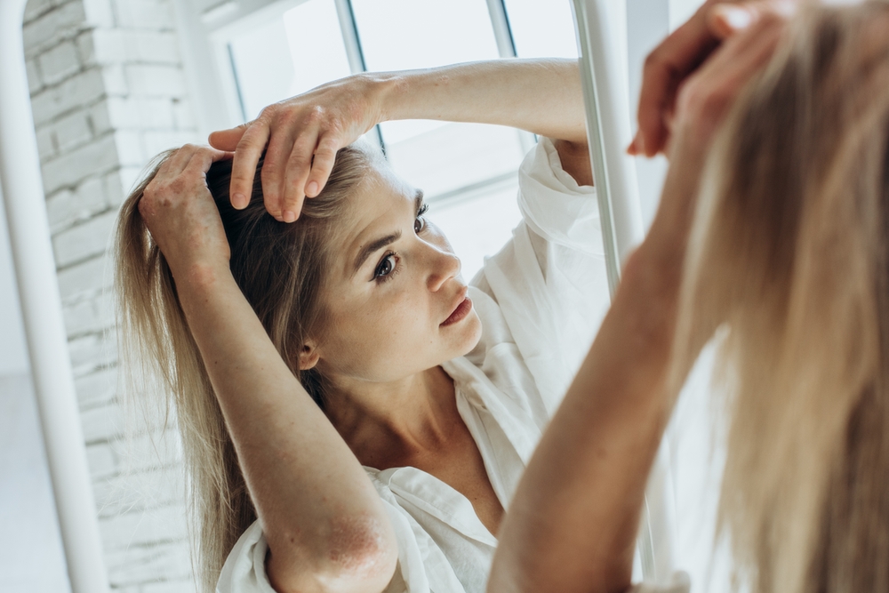 Młoda kobieta z łuszczycą głowy przegląda się w lustrze