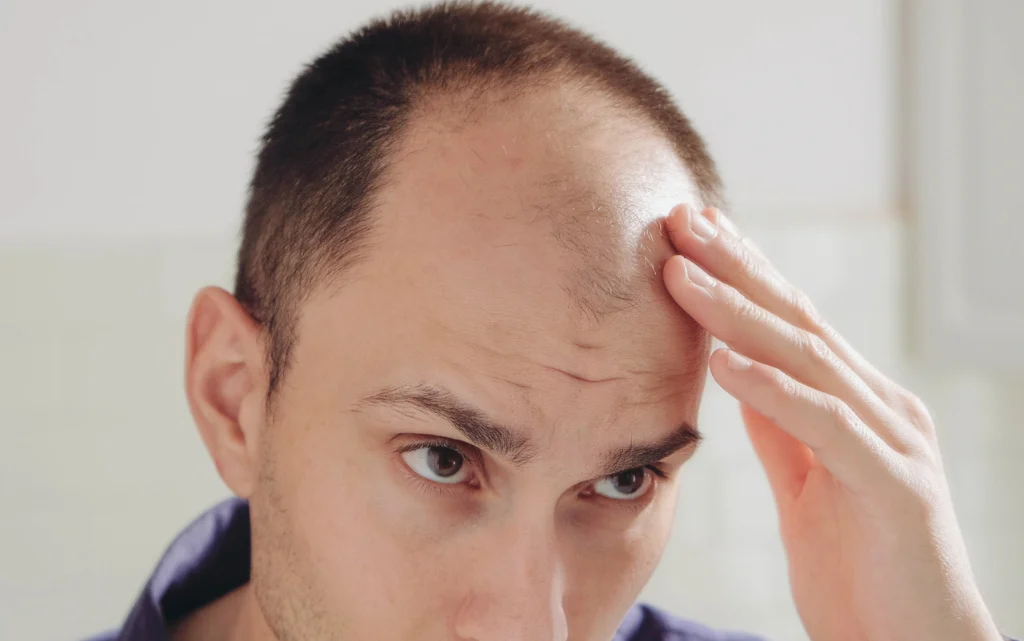 Mężczyzna łysiejący w młodym wieku