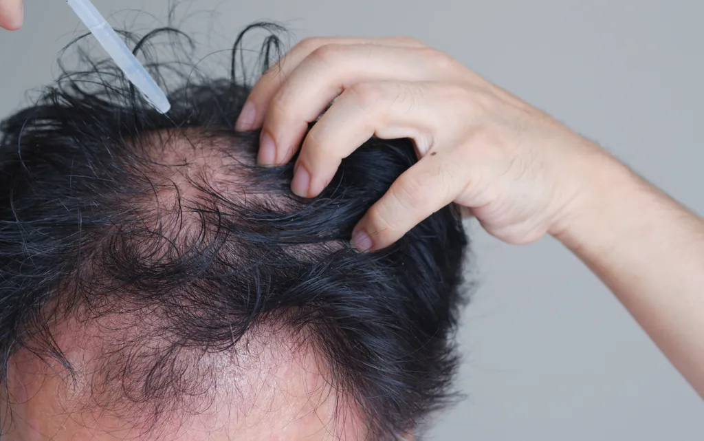 Aplikacja preparatu przeciw łysieniu przy użyciu pipety